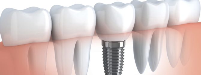 implante-dental-1