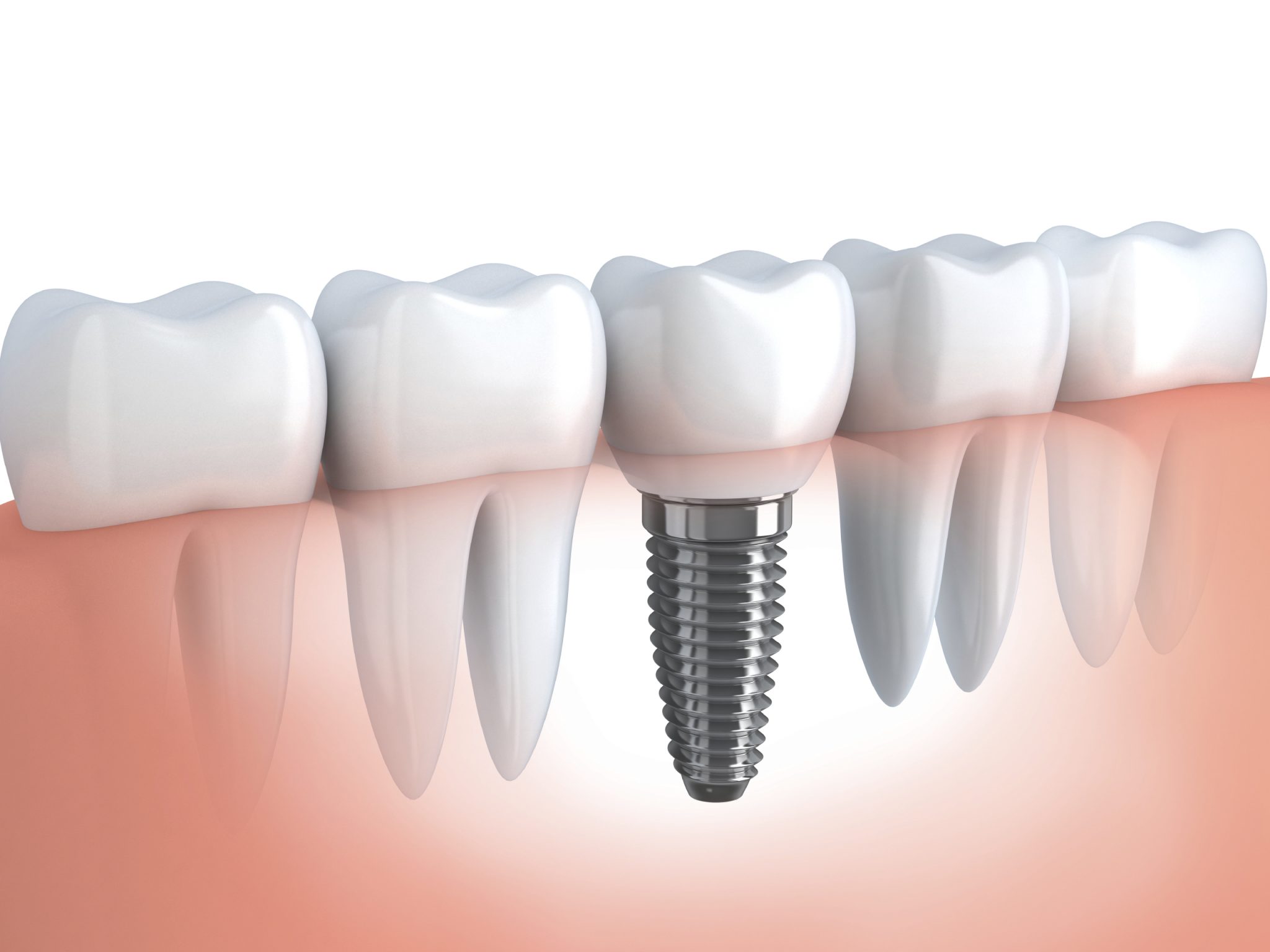 implante-dental-1